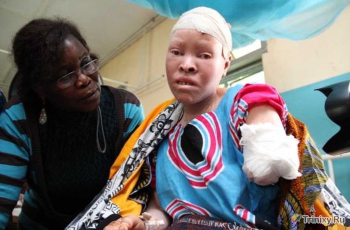 Жуткая судьба альбиносов Танзании (11 фото)