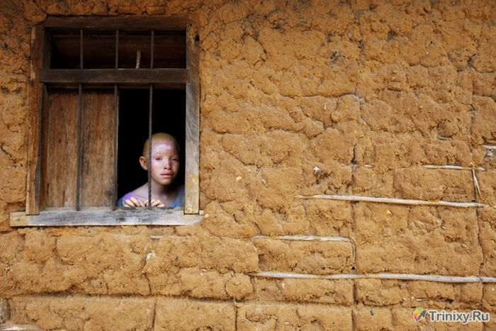 Жуткая судьба альбиносов Танзании (11 фото)